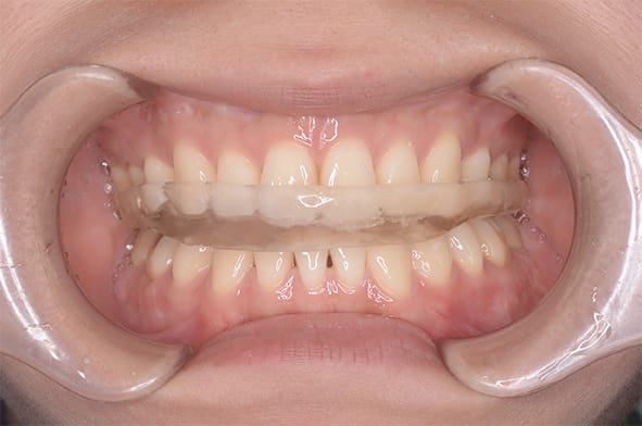 顎関節症の治療について